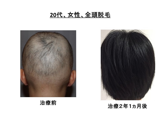 円形脱毛症　病院